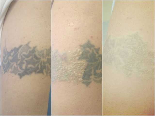 Предложение: Лазерное удаление татуировок и татуажа