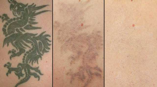 Предложение: удаление татуировок, микроблейдинга