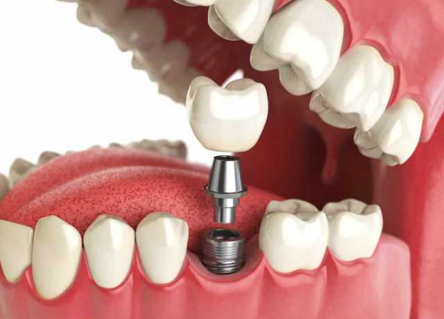 Предложение: Импланты зубов Все на 4 имплантах