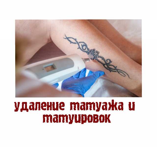 Предложение: Удаление татуажа и татуировок