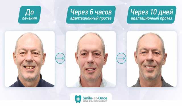 Предложение: базальная имплантация зубов в Москве