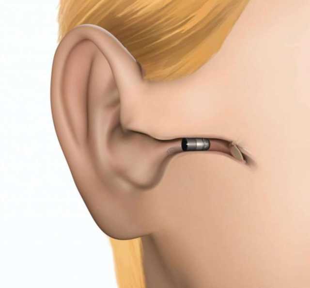 Продам: Внутриканальный слуховой аппарат AMP Microtech