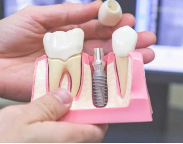 Предложение: Услуги по имплантации зубов