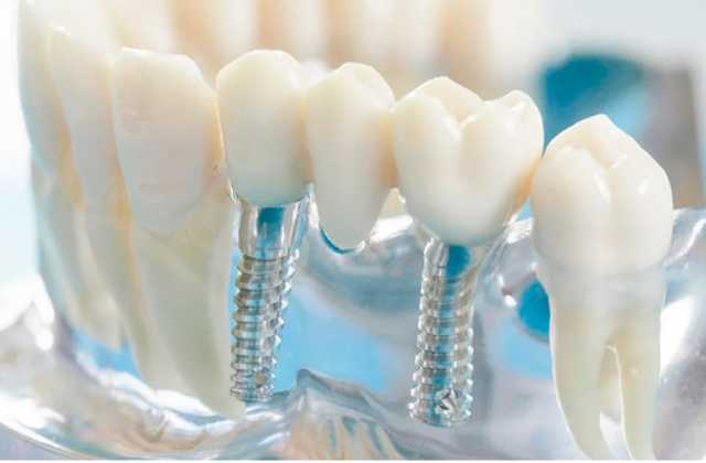 Предложение: Имплантации зубов