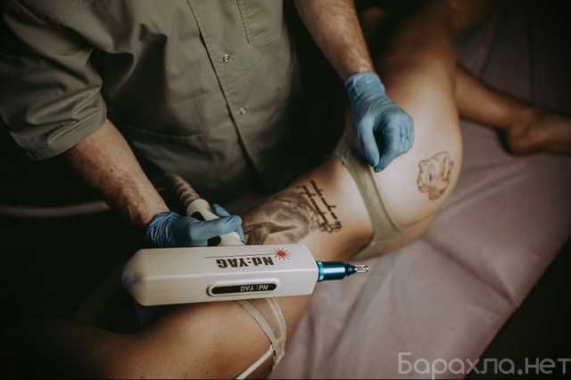 Предложение: Удаление татуировок лазером