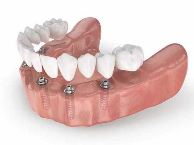 Предложение: Изготовление зубных протезов