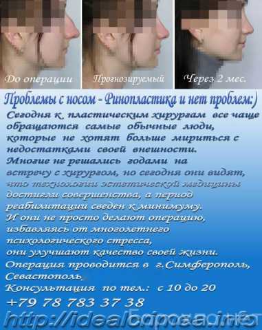 Предложение: Ринопластика - изменить размер или форму
