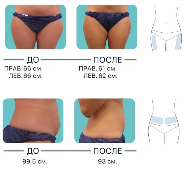 Предложение: Криополиз - похудение без диет: уберём ж