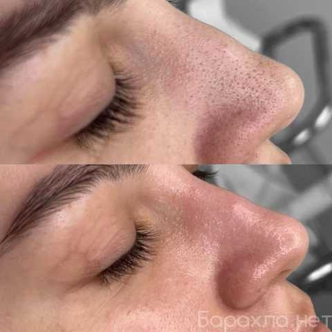 Предложение: Косметолог, Чистка лица